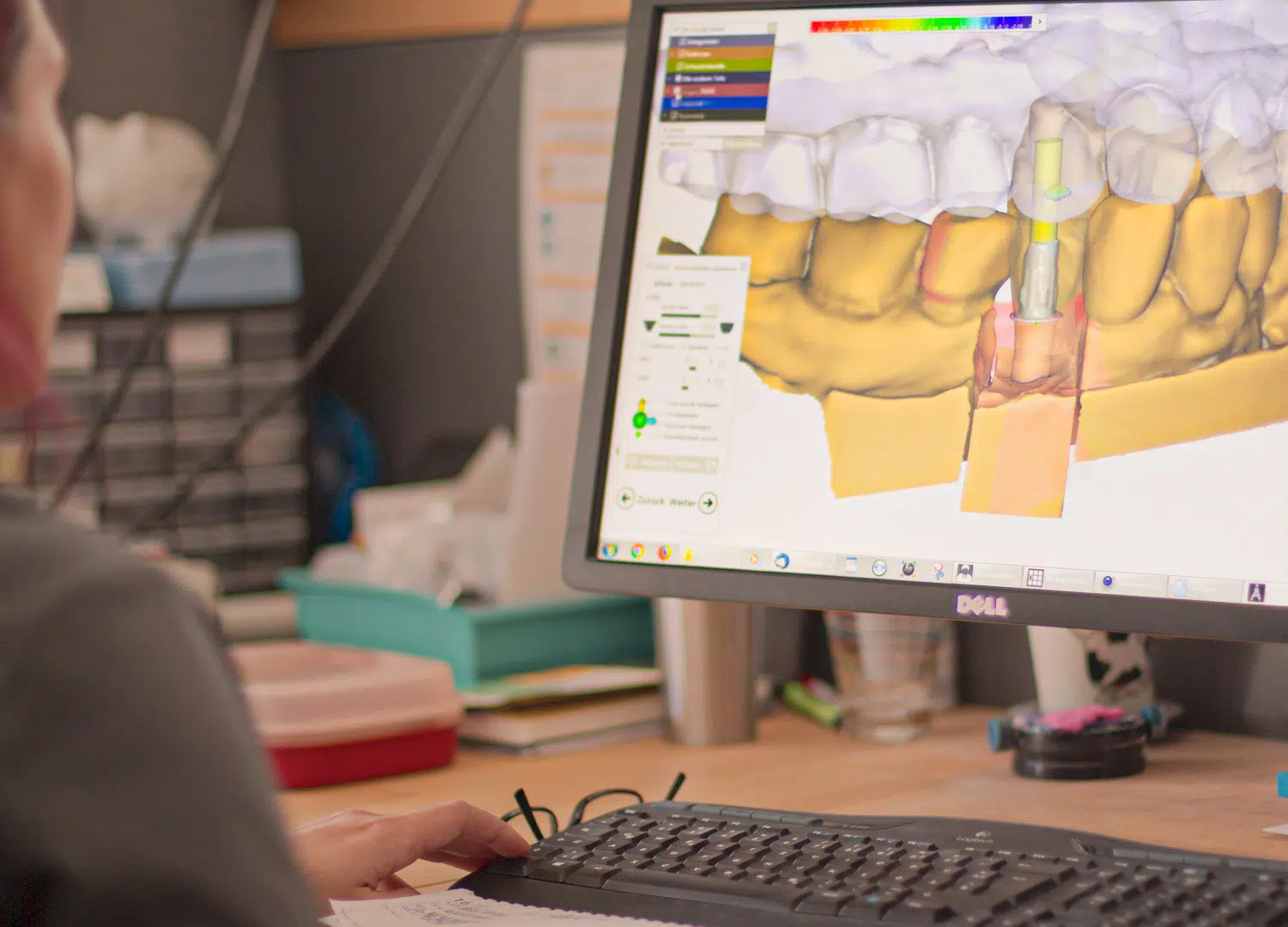 CAD-Arbeitsplatz mit Implantatplanung am Bildschirm
